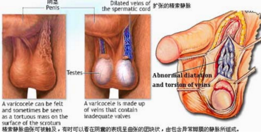 睾丸静脉曲张