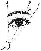 双眼皮失败修复术