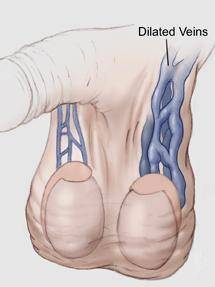 左侧精索静脉曲张