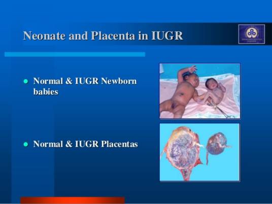 胎儿宫内发育迟缓