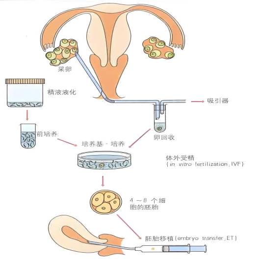 体外受精