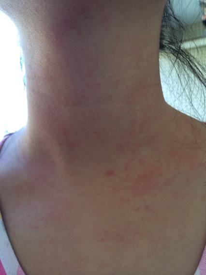 急性过敏性荨麻疹