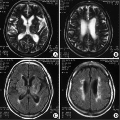 脑白质疏松症