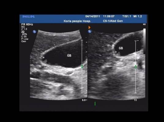 多发性胆囊息肉
